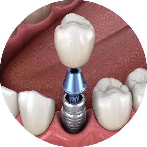dental implants model 2 (1)