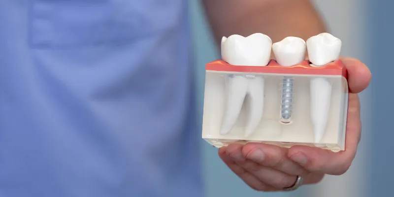 dental implants model 4