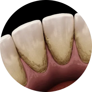 dental plaque graphic