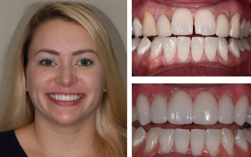 dental veneers 1