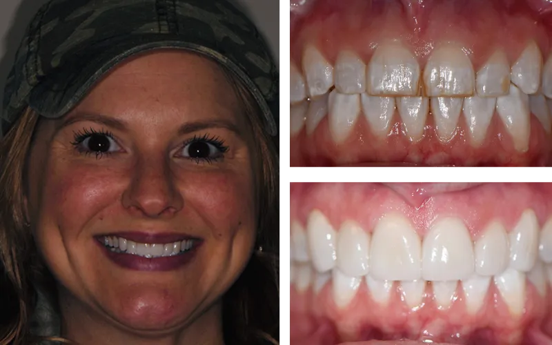 dental veneers 2
