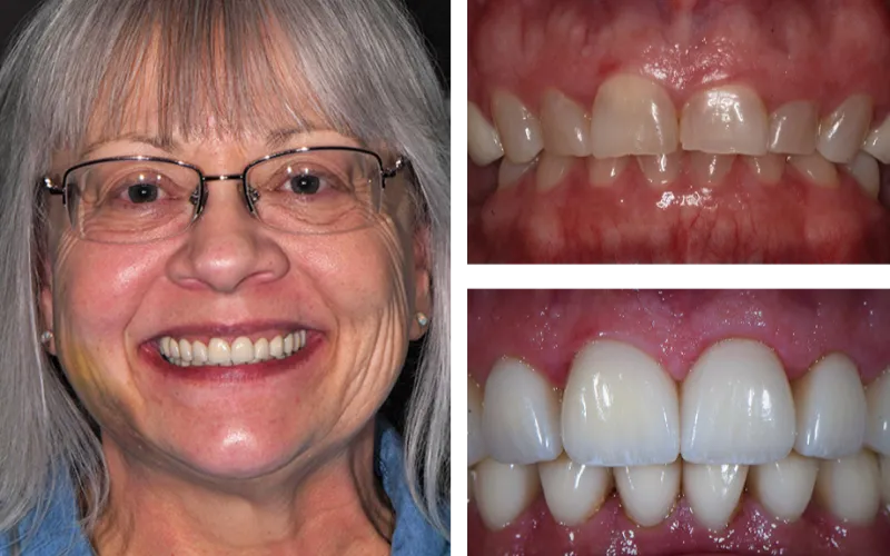 dental veneers 3