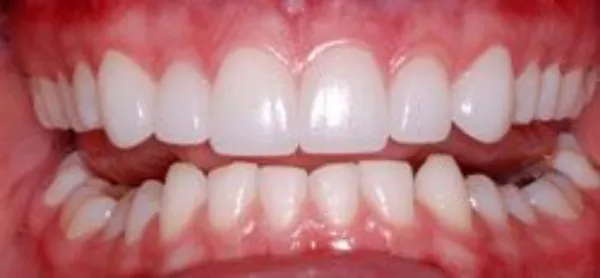 dental veneers after 10