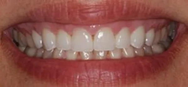 dental veneers after 5