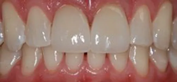 dental veneers after 6