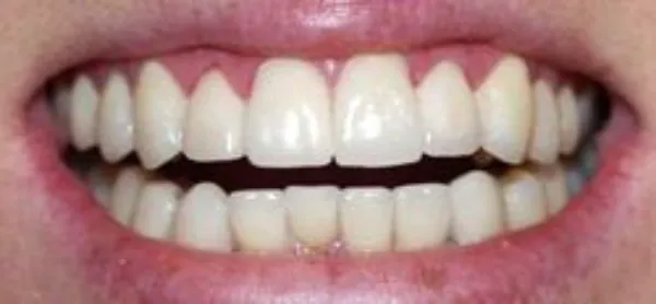 dental veneers after 7