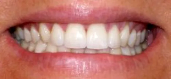 dental veneers after 9
