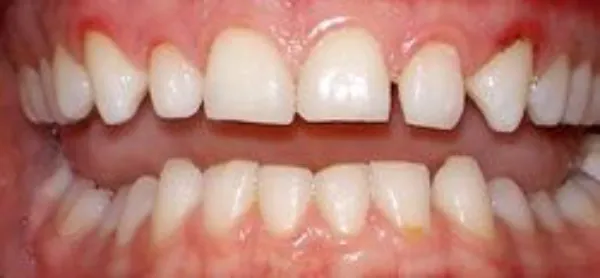 dental veneers before 10