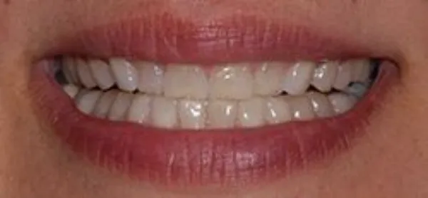 dental veneers before 5
