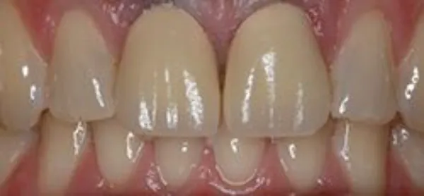dental veneers before 6