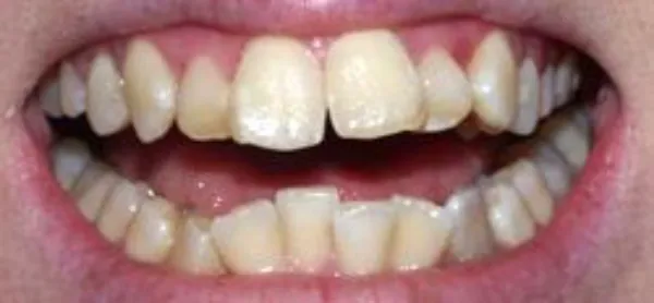 dental veneers before 7