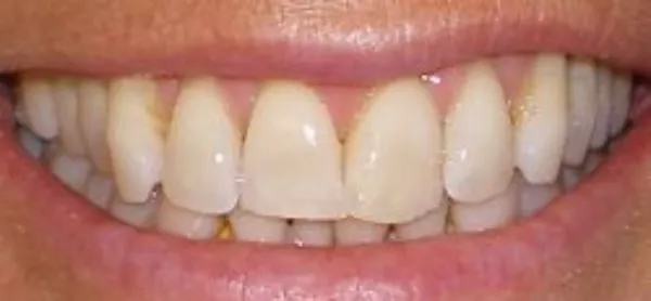 dental veneers before 8