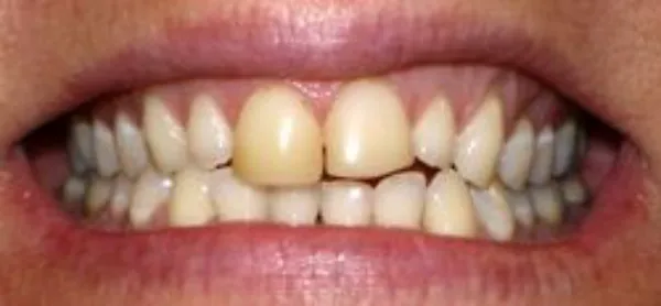dental veneers before 9