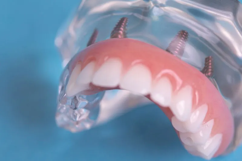 full arch dental implants model (1)