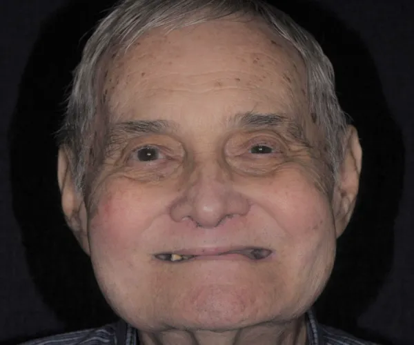 fullarchimplant allon4 before tabor