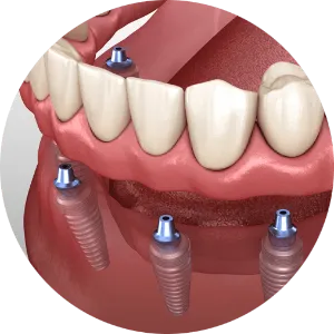 implant supported denture (1)