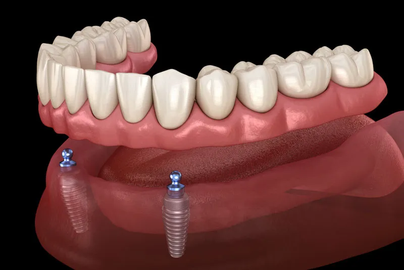 implant supported dentures model 2 (1)