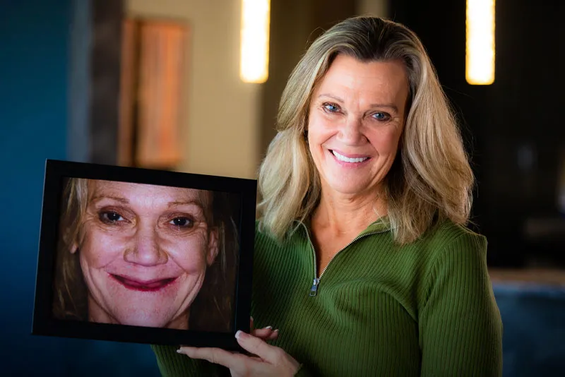 jennifer full arch dental implants patient