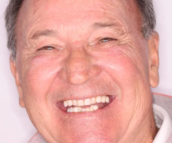 jim fixed implants 1365x2048