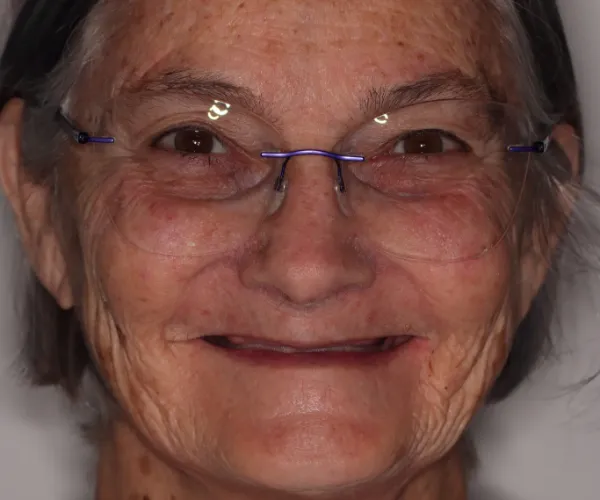 nan fixed implants 1365x2048