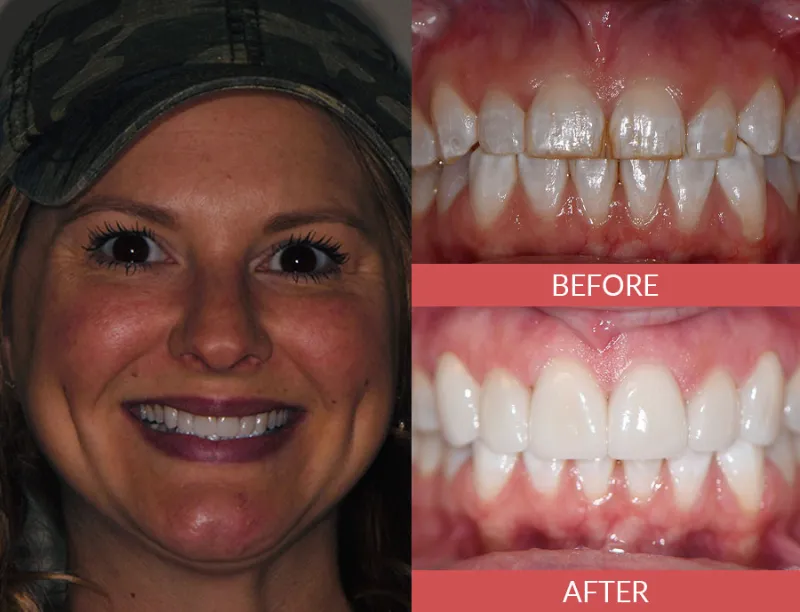 porcelain veneers before and after 1