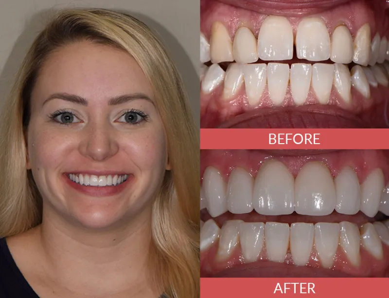 porcelain veneers before and after 2