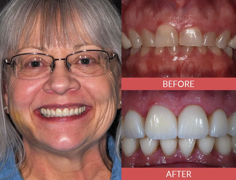 smile makeover before and after