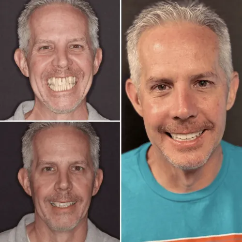 steve c fixed implants full face 1