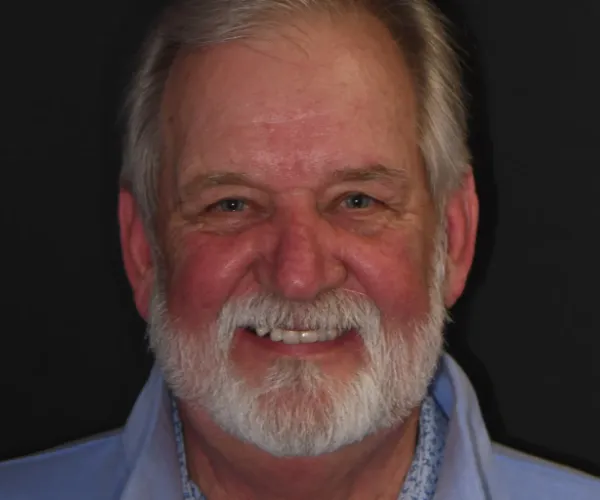 steve m fixed implants 1536x1024