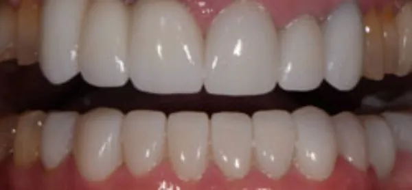 veneer bridge after tabor