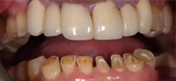 veneer bridge before tabor