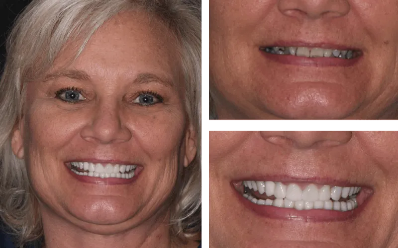 veneer crowns both tabor2