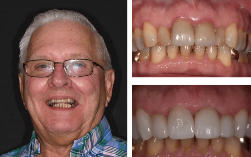 veneer upper both tabor