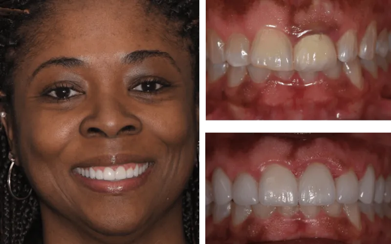 veneer upper gum both tabor