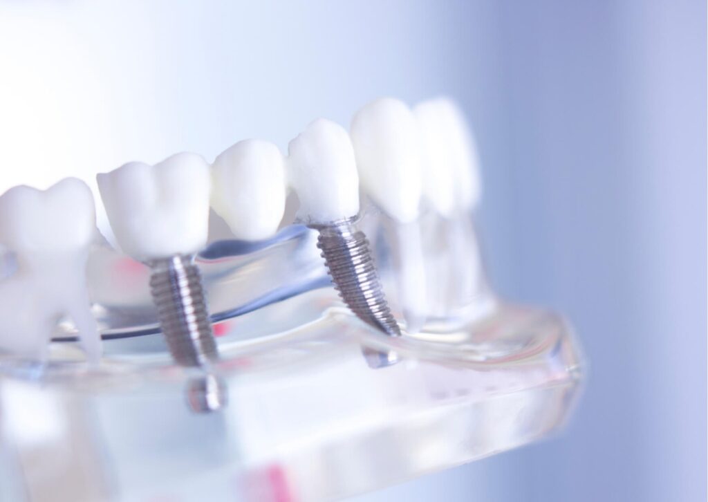 Close-up dental implant model showing implant-supported replacement teeth, illustrating the pros and cons of dental implants for long-term tooth replacement.