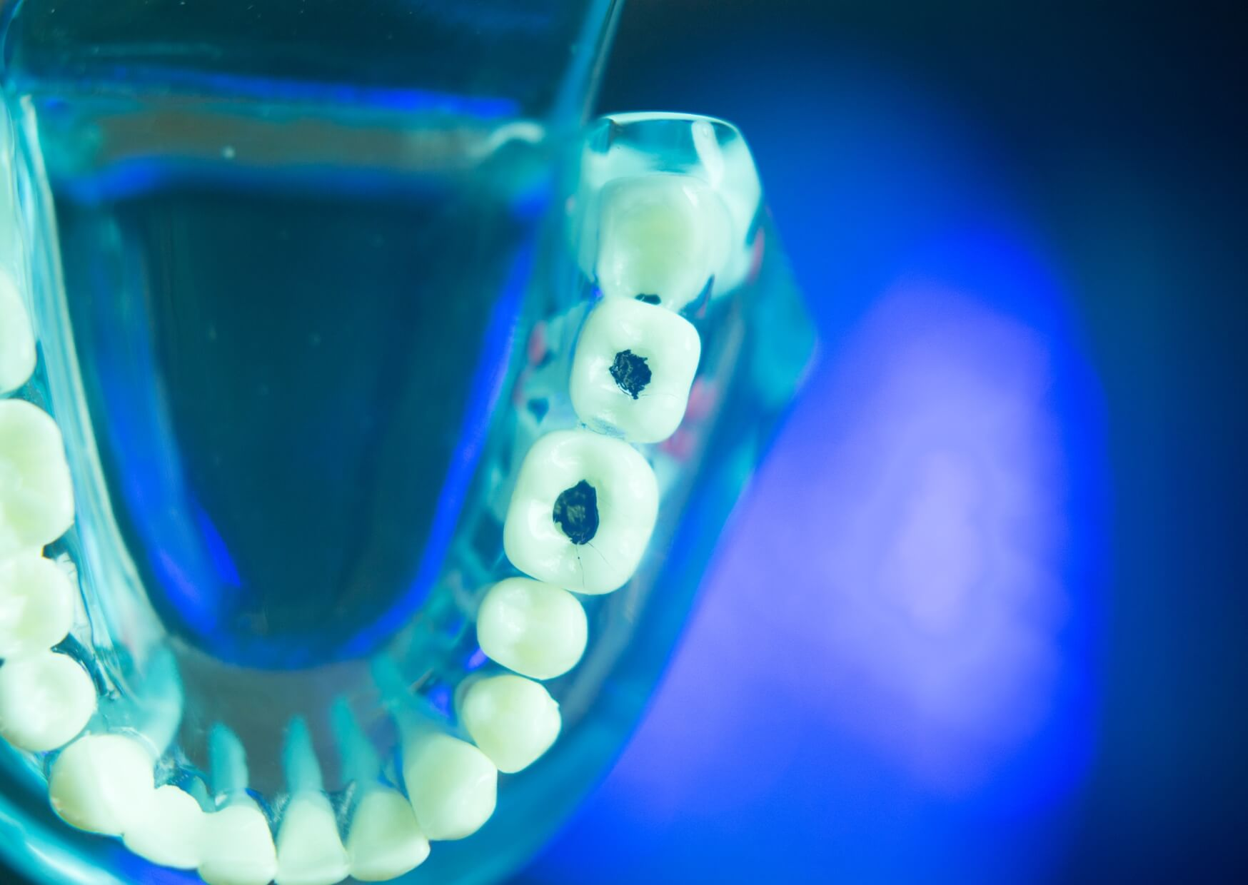 Close-up dental model showing dark cavities on molars to illustrate what tooth decay looks like in its early stages.