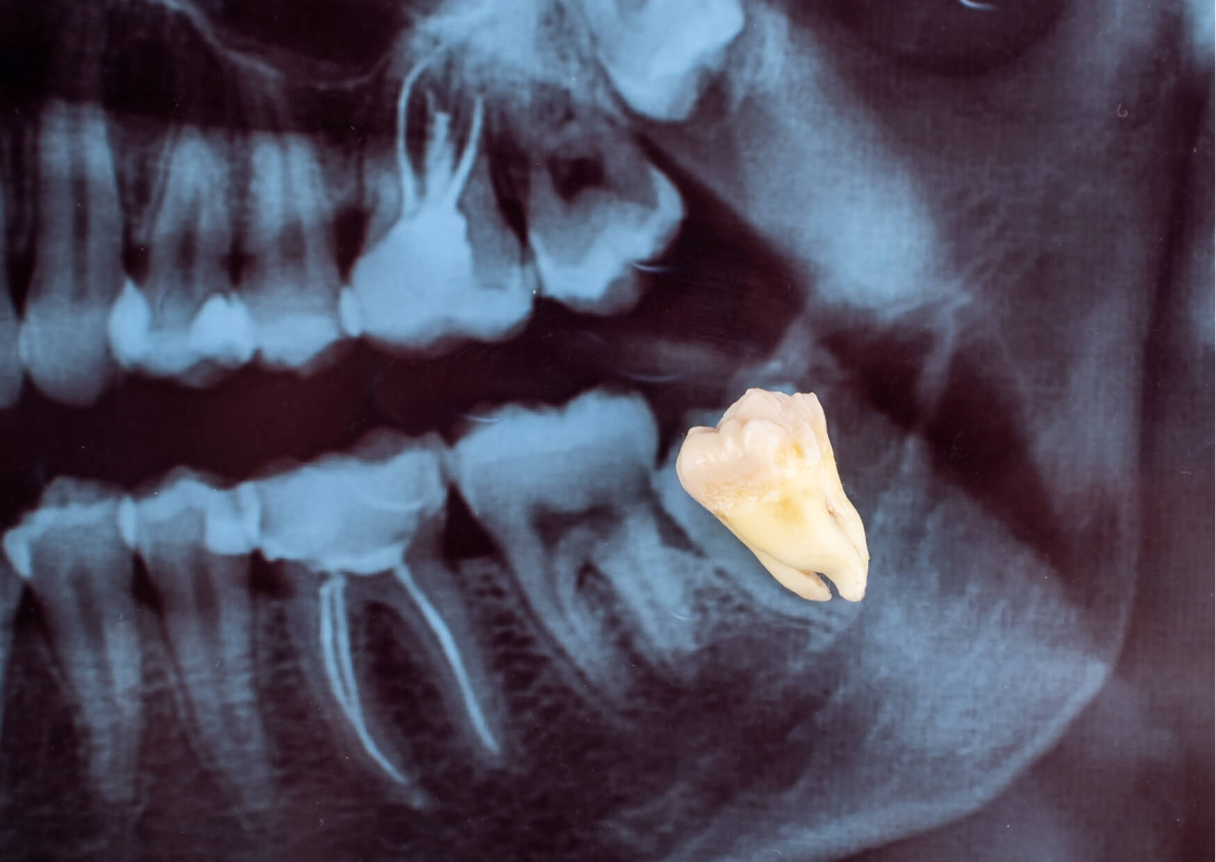Dental X-ray showing an impacted wisdom tooth beneath the gums, illustrating why wisdom tooth eruption can take longer than expected.