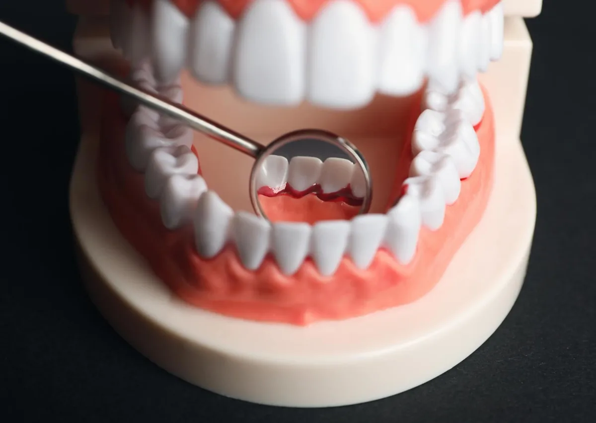 Dental model showing receding gums and exposed tooth roots during a gum recession examination.